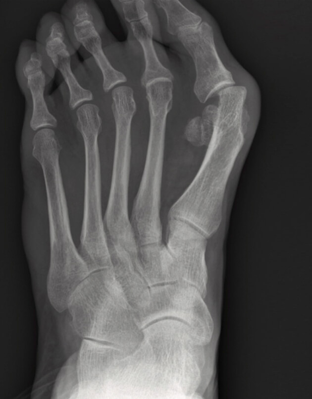 Minimaal invasieve chirurgie voor de hallux valgus