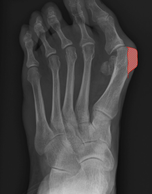 Minimaal invasieve chirurgie voor de hallux valgus