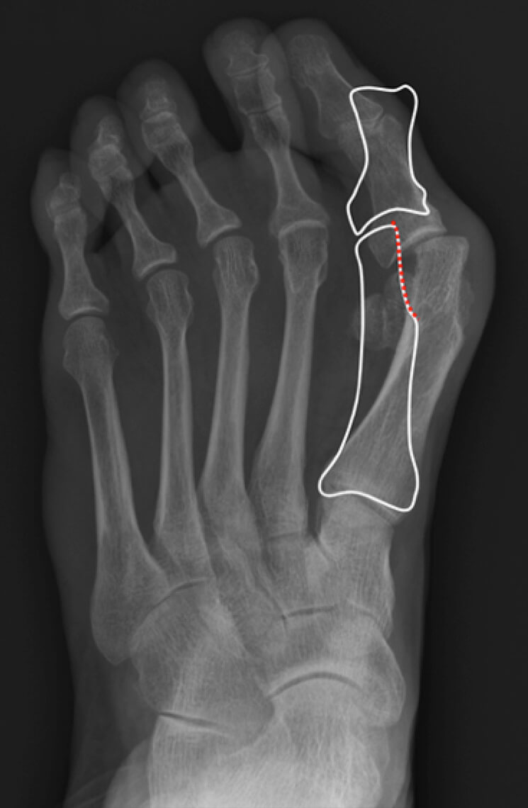 Minimaal invasieve chirurgie voor de hallux valgus