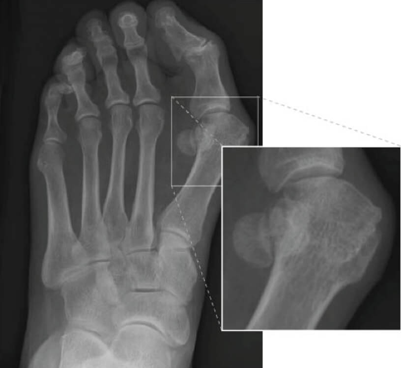 Minimaal invasieve chirurgie voor de hallux valgus