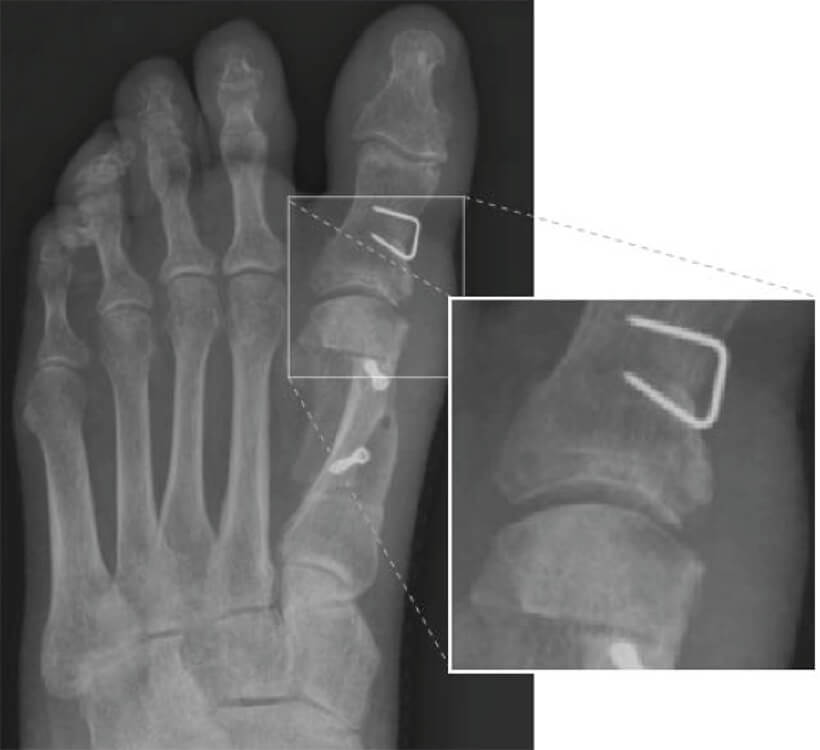 Minimaal invasieve chirurgie voor de hallux valgus