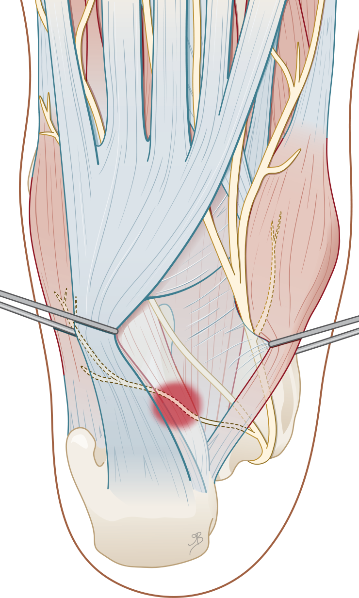 Abductor hallucis longus en de musculus quadratus