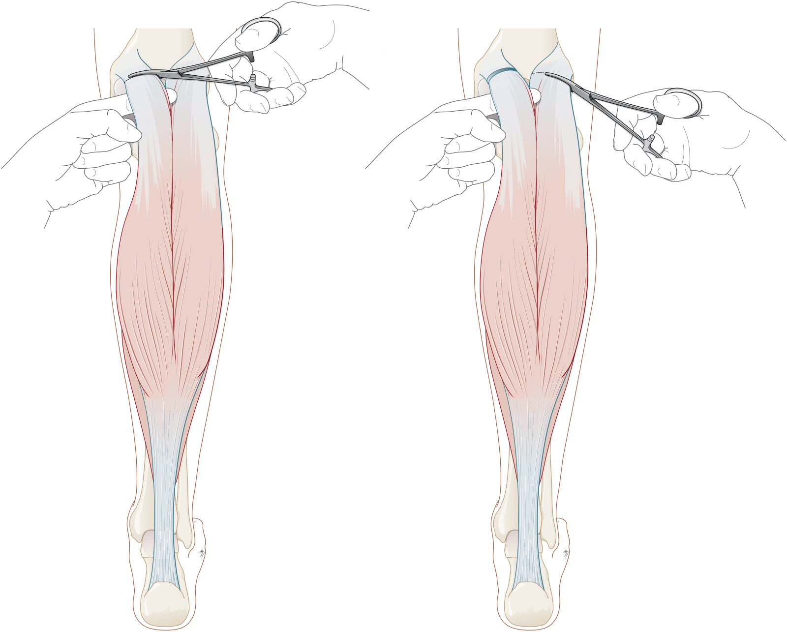 Kuitspierverlenging