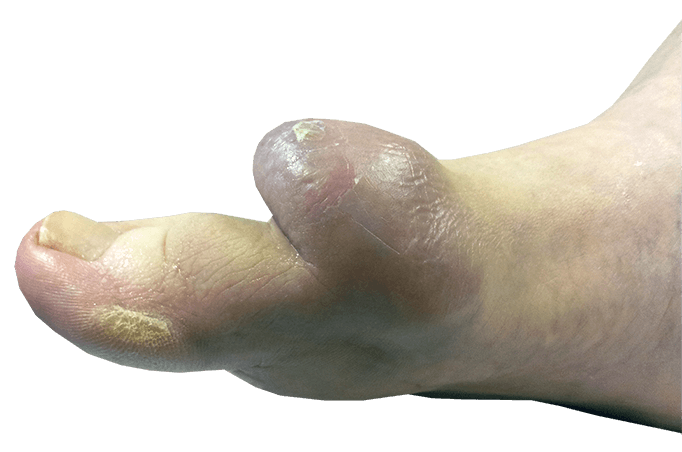 Diagnose van een hallux rigidus