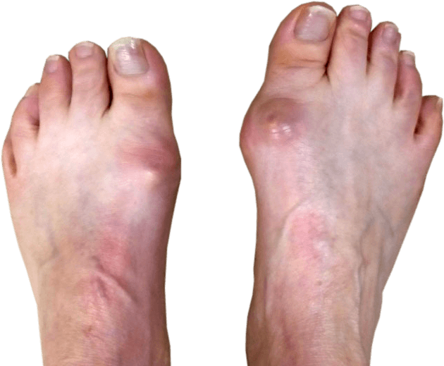 Diagnose van een hallux rigidus