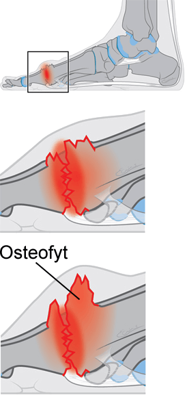 Osteofyten bij stijve grote teen