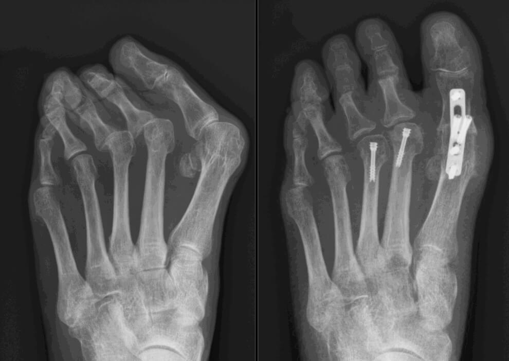 MTP-I artrodese bij hallux valgus