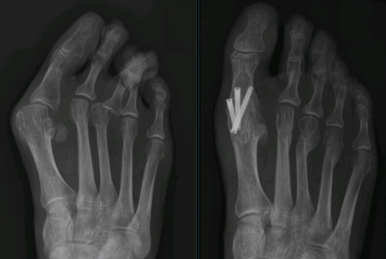 MTP-I artrodese bij hallux valgus