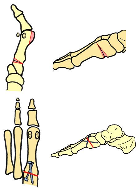 TMT-I artrodese bij hallux valgus