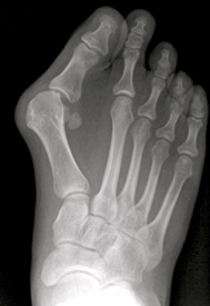 TMT-I artrodese bij hallux valgus