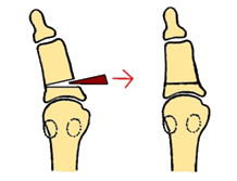 Akin osteotomie bij hallux valgus