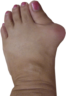 Hallux valgus