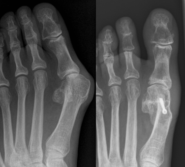 Chevron osteotomie bij hallux valgus