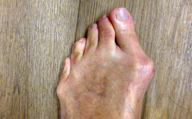 Diagnose van een hallux valgus