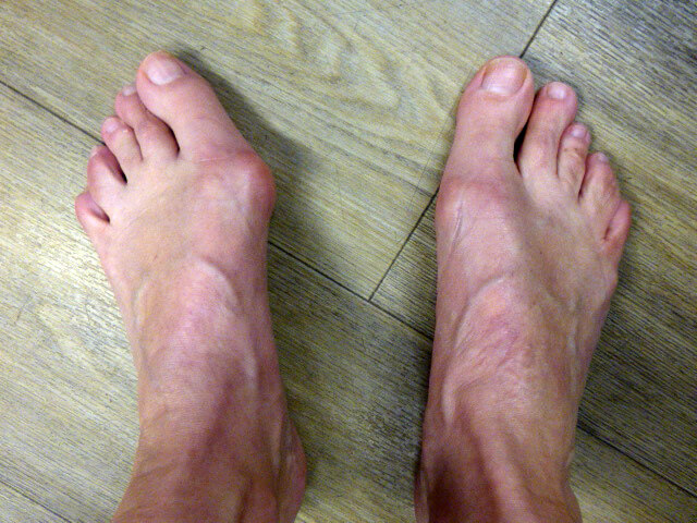 Diagnose van een hallux valgus