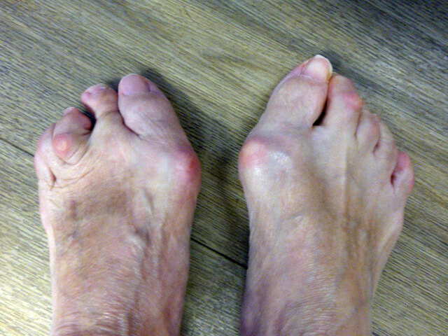 Diagnose van een hallux valgus