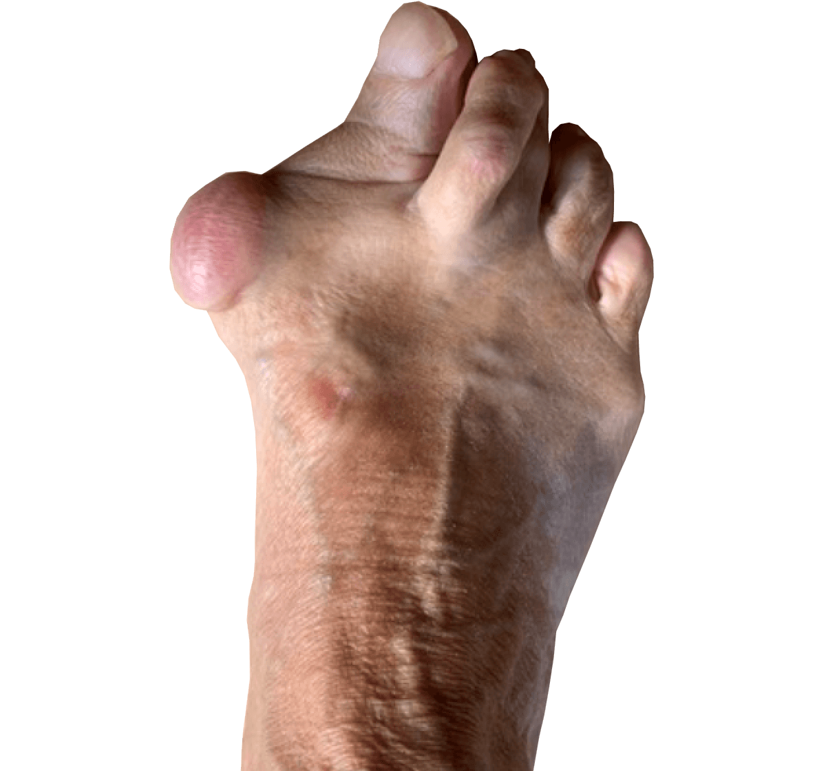 Diagnose van een hallux valgus