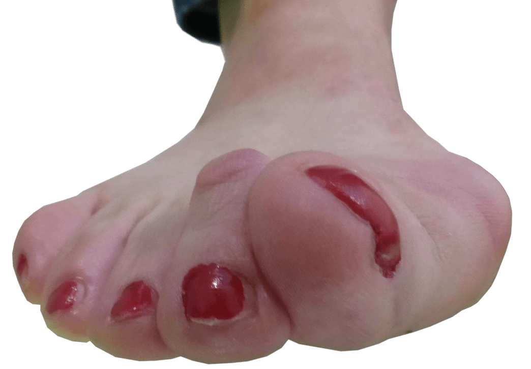 Diagnose van een hallux valgus