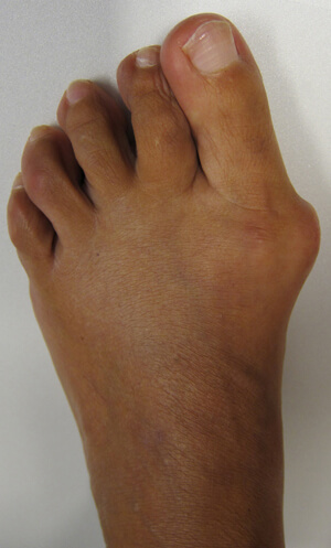 Hallux valgus