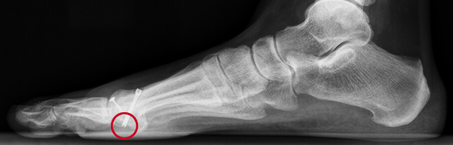 Klachten na het opereren van een hallux valgus