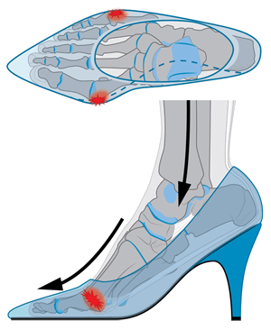 Oorzaak van een hallux valgus