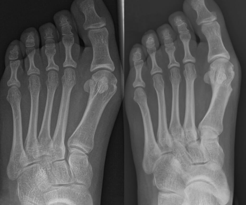 Klachten na het opereren van een hallux valgus