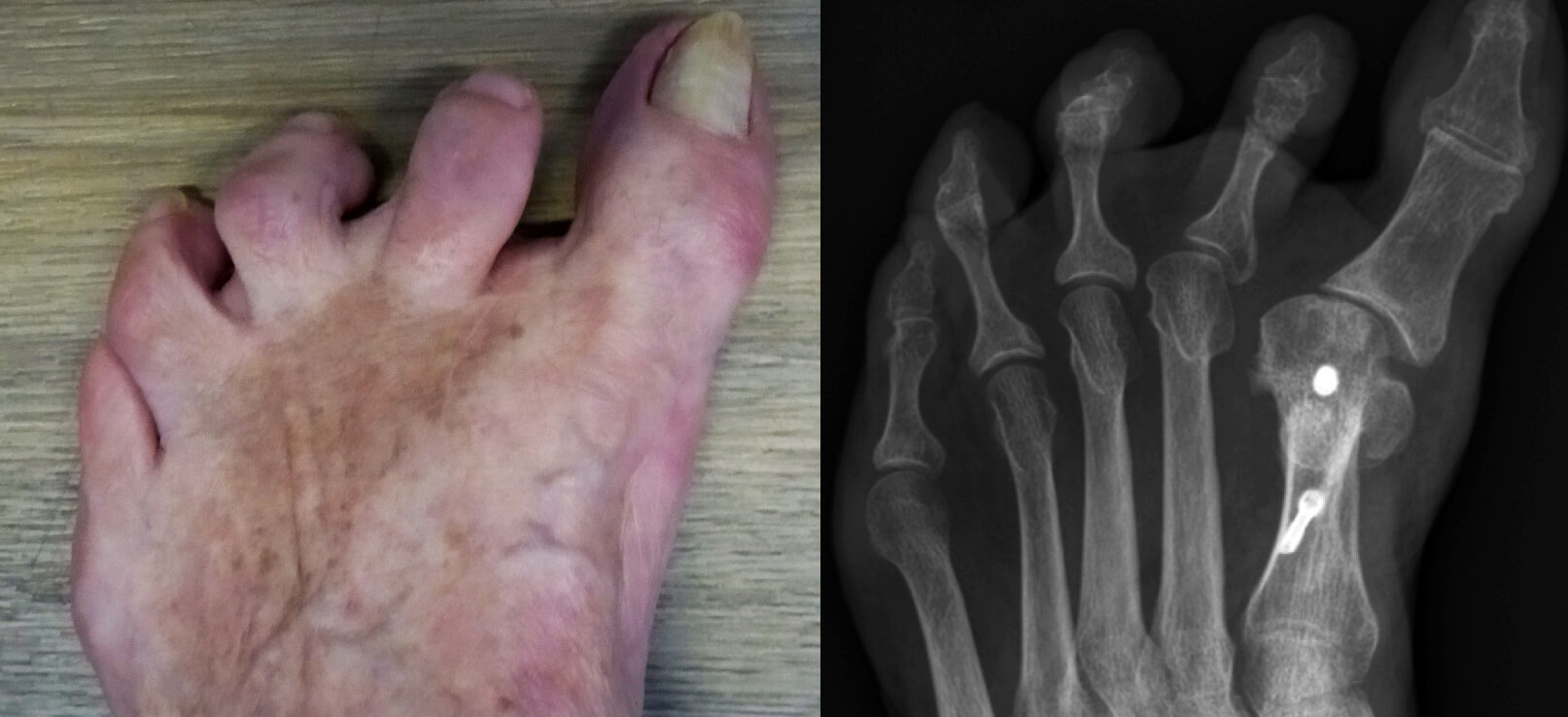 Klachten na het opereren van een hallux valgus