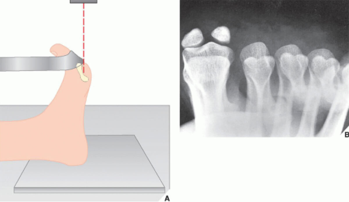 Klachten na het opereren van een hallux valgus