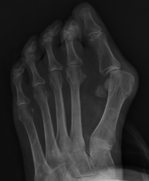 Diagnose van een hallux valgus