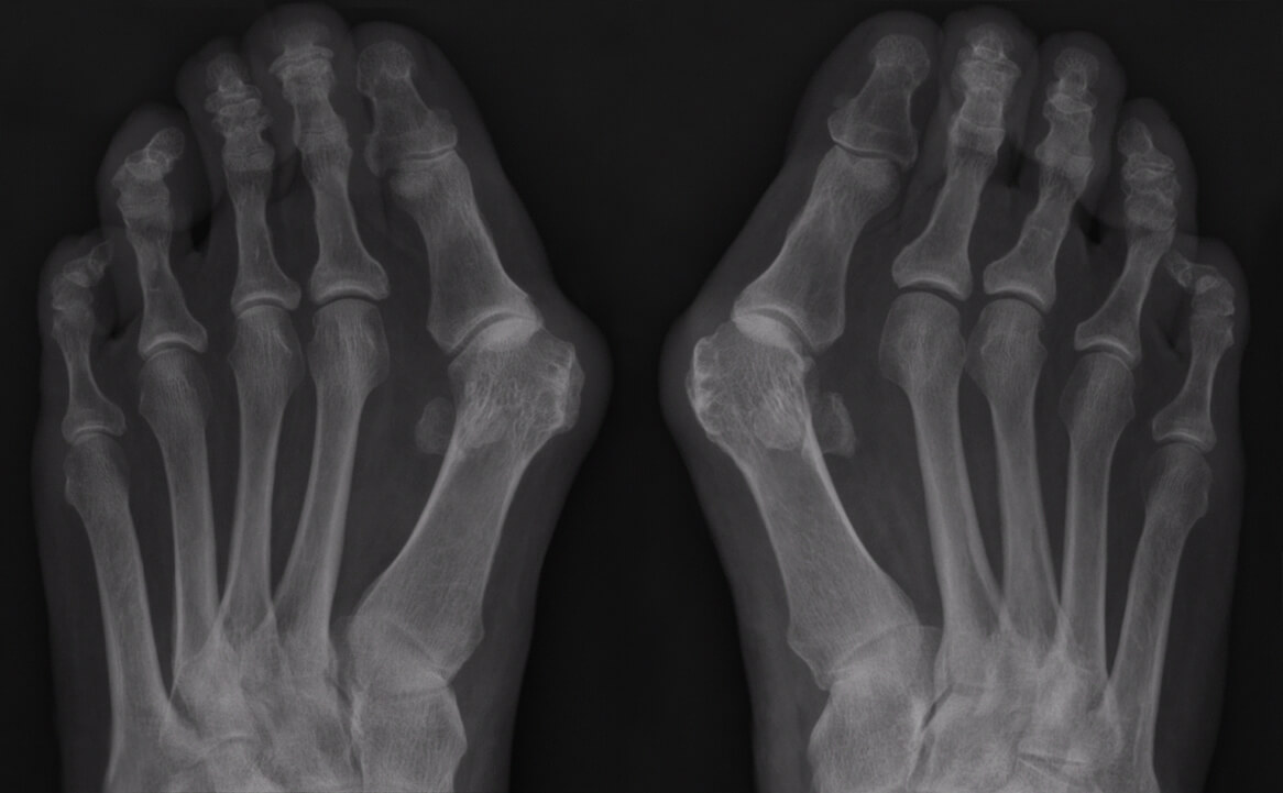 Diagnose van een hallux valgus