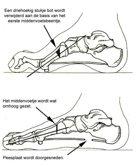 Doorsnijden van de peesplaat