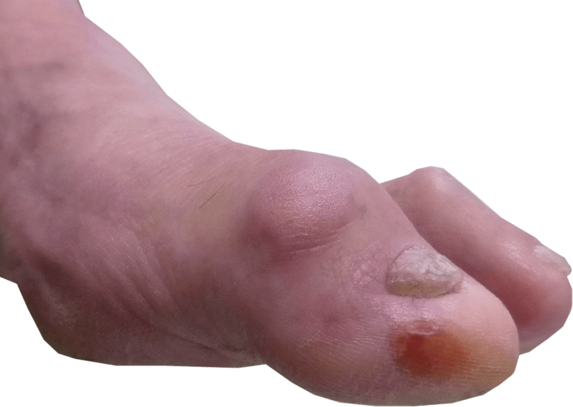 Diagnose van artrose in de grote teen