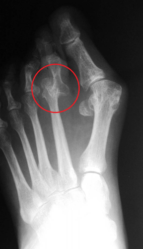 Hallux valgus