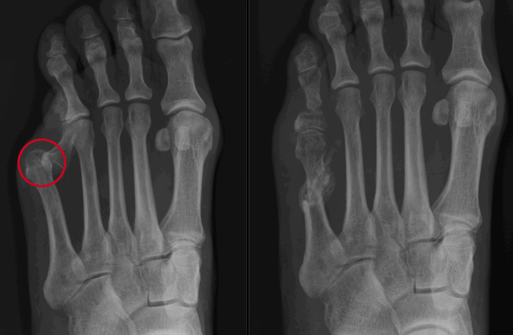 Röntgenfoto van scheve kleine teen voor en na de operatie