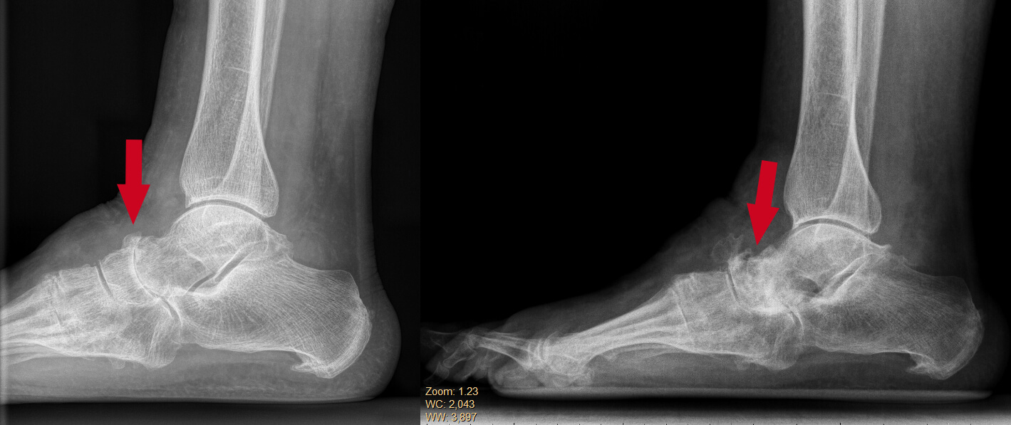 Ziekte van Müller Weiss