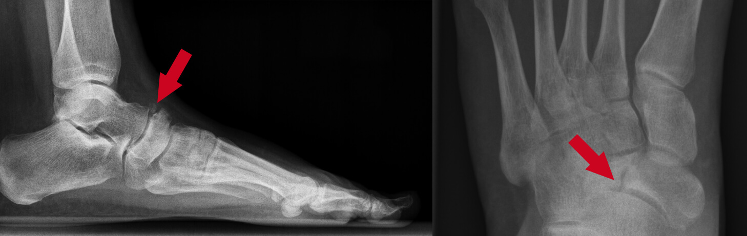 Ziekte van Müller Weiss