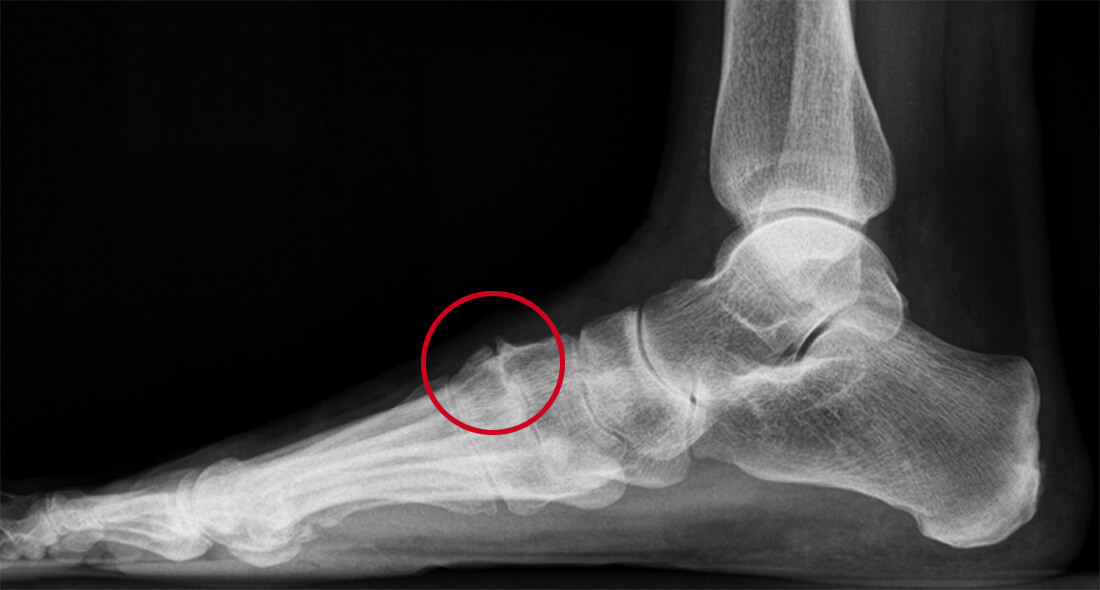 Röntgenfoto van botuitsteeksel op de wreef