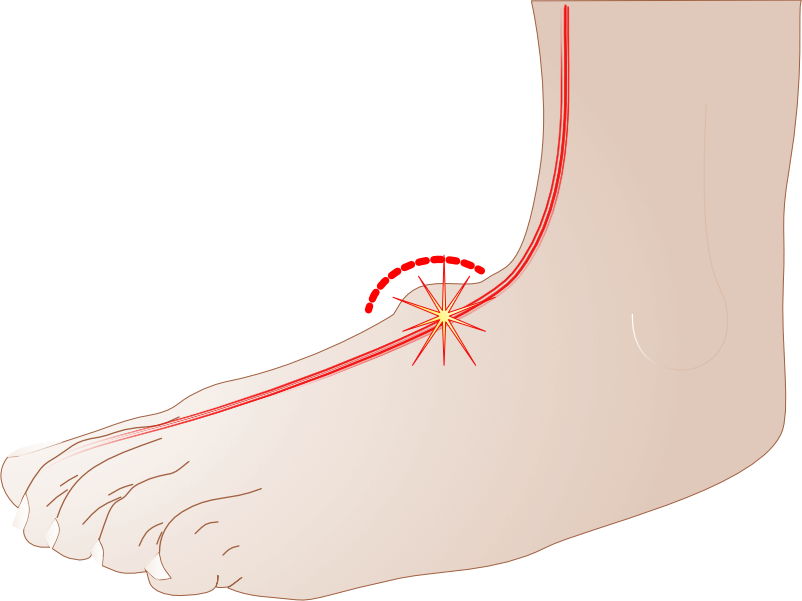 Verdikking op de wreef (tarsal boss) Verdikking op de wreef (tarsal boss)