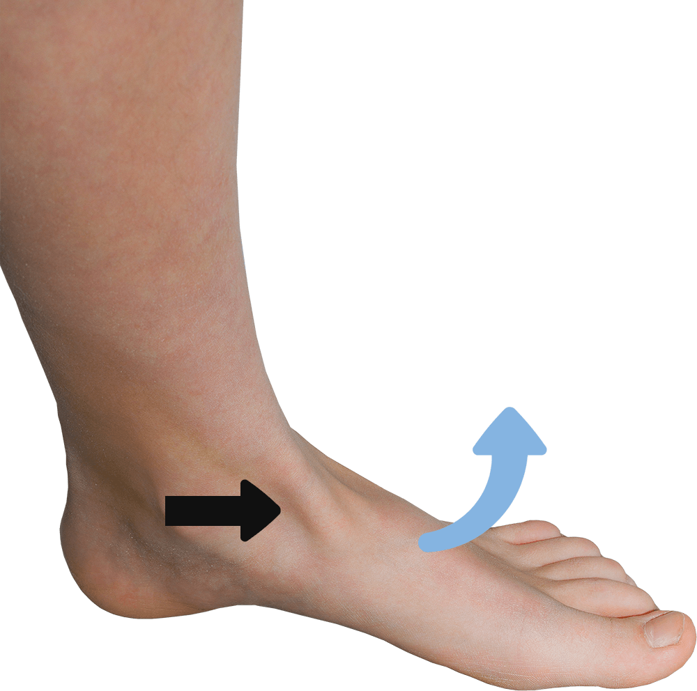 De blauwe pijl geeft de beweging van de voet aan die de tibialis anteriorspier (zwarte pijl) maakt