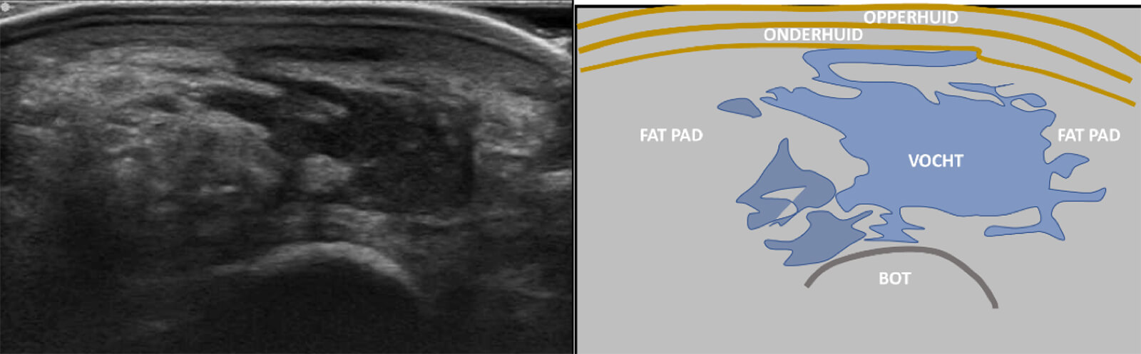 Echobeeld van het vetkussen onder de voet