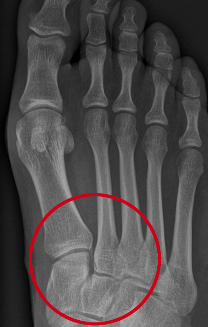 Gezond Lisfranc gewricht